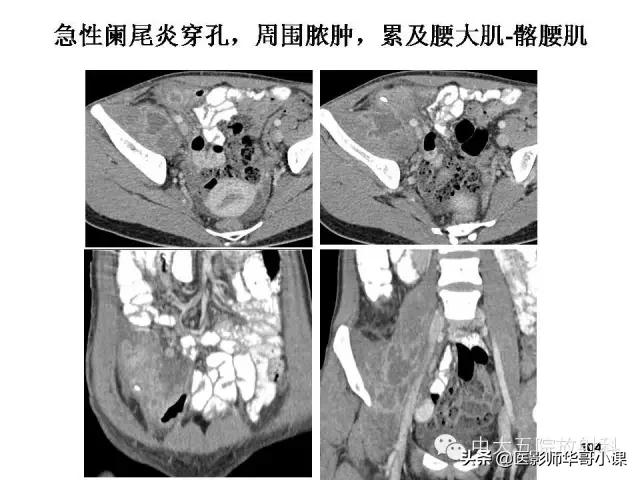 阑尾炎课件,阑尾炎的超声课件