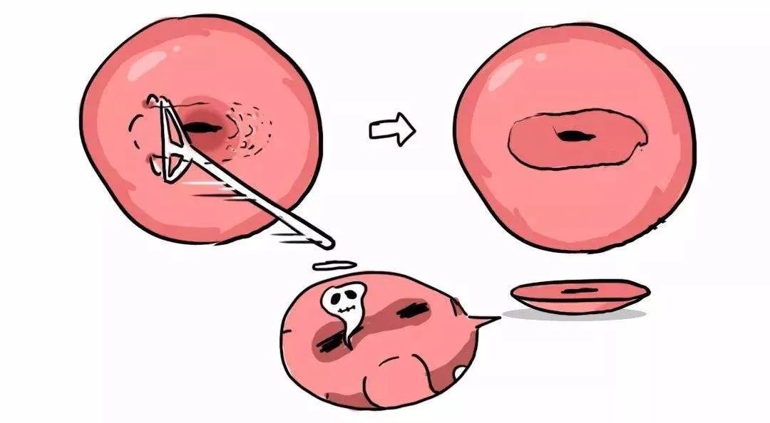 宫颈癌前病变变癌几率,宫颈癌的前兆最明显有什么表现