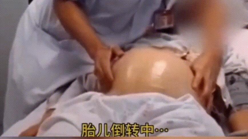 孩子臀位无法顺产，医生徒手将孩子转正，会这个技术的不多了