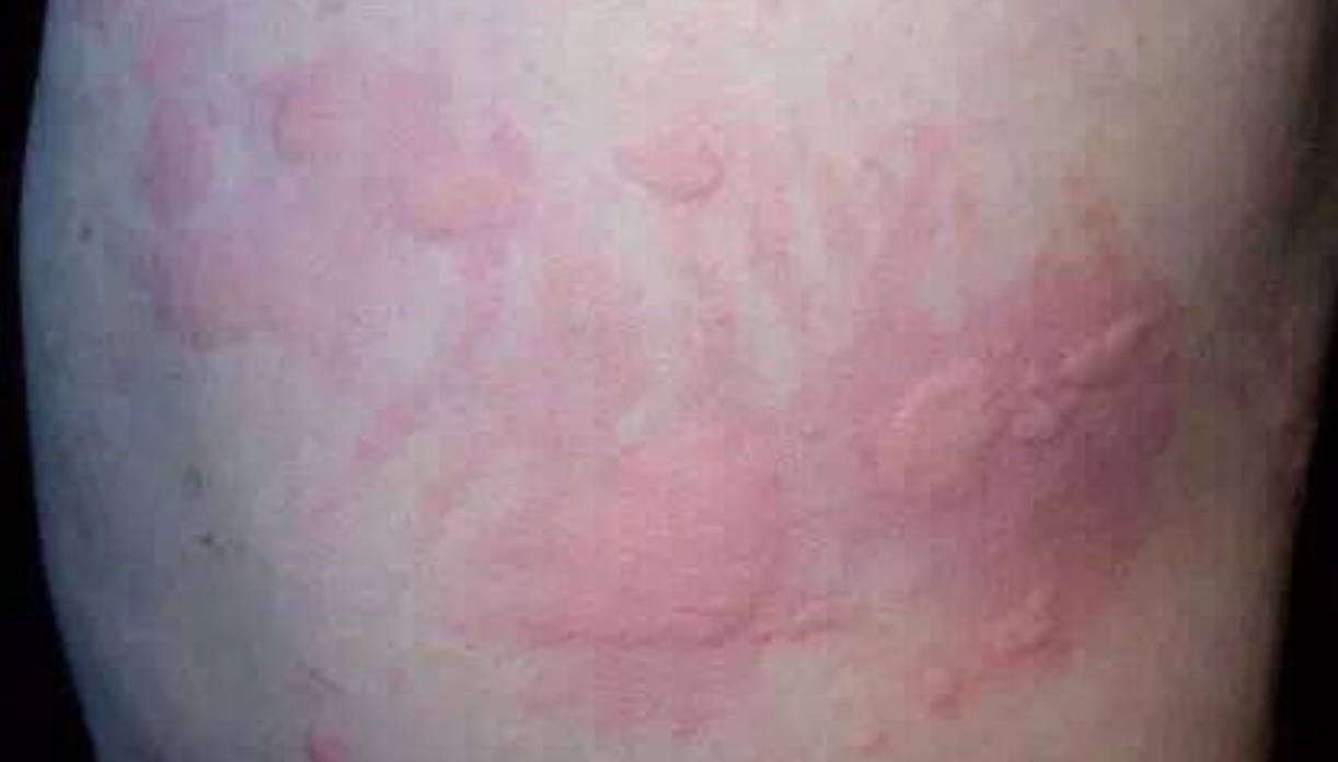 如何判断婴儿湿疹还是脂溢性皮炎,宝宝脂溢性皮炎是干性湿疹吗