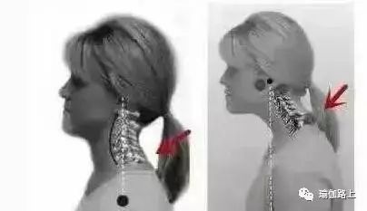 脖子越来越粗是什么原因造成的,脖子粗怎么判断是病了还是胖了