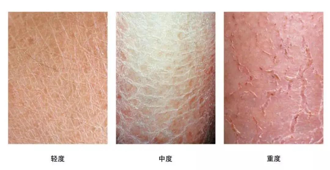 冬季皮肤瘙痒是怎么回事,冬季皮肤瘙痒是怎么回事啊