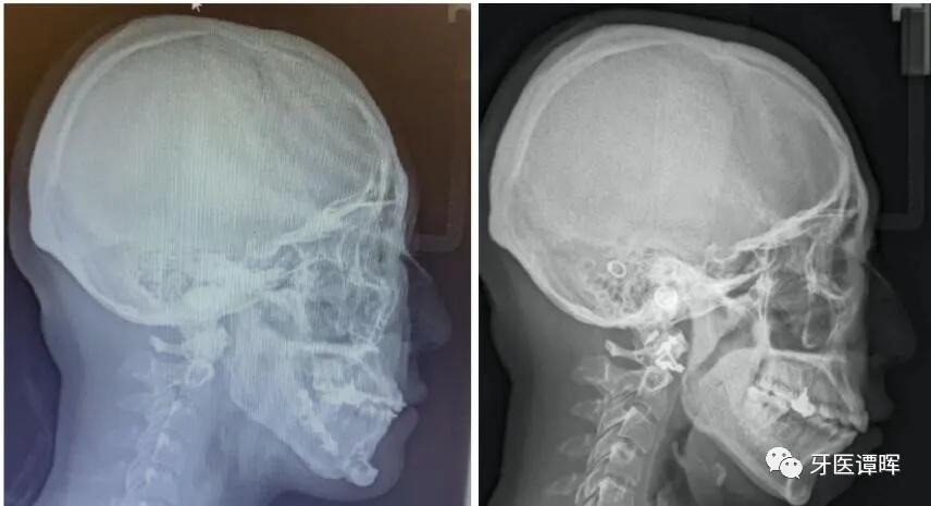 超详细的牙齿矫正过程,成人骨性牙齿矫正过程