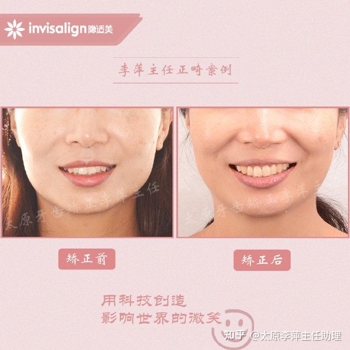 重度拥挤矫正牙齿适合隐形牙套吗,广州成人牙齿矫正推荐隐形牙套