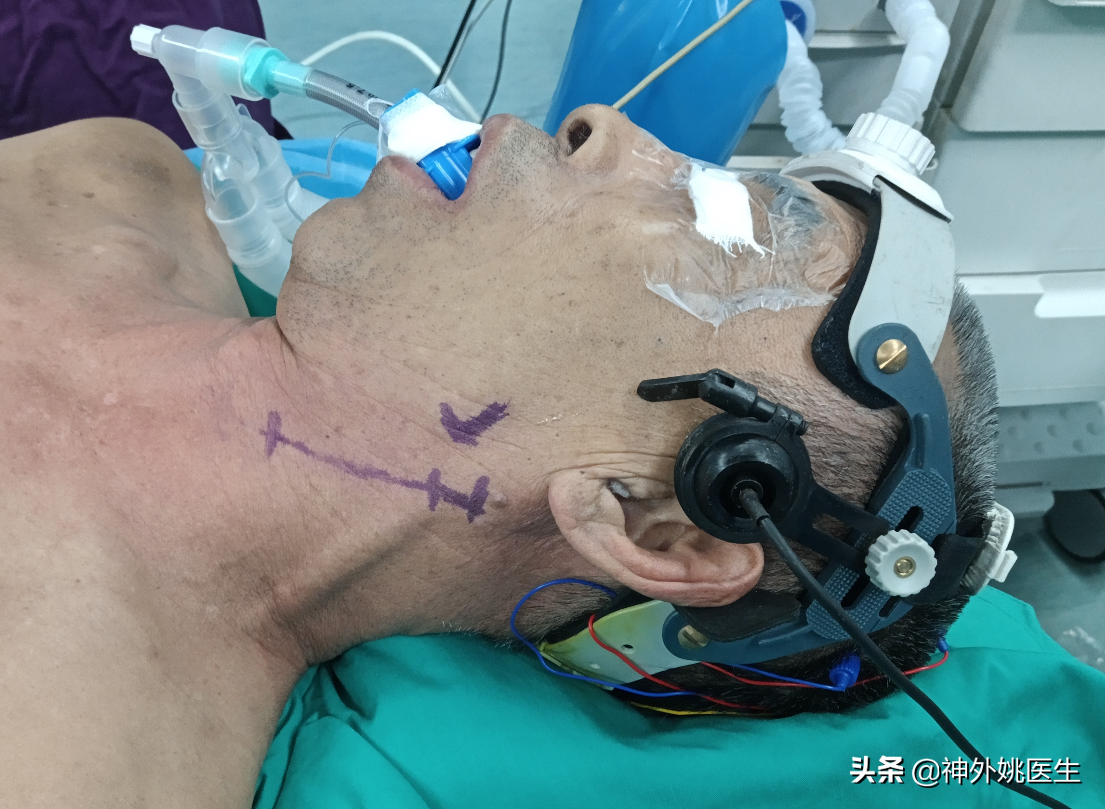 颈动脉狭窄的外科治疗