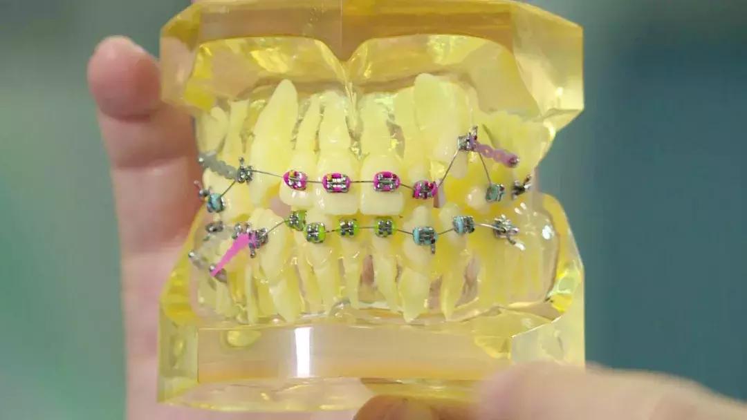 孩子牙齿长歪了怎么办？什么时候适合做矫正？