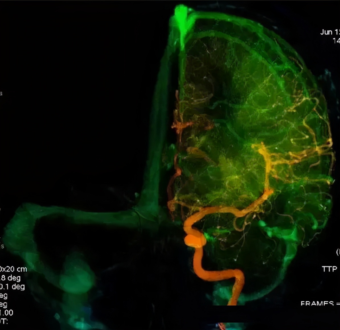 脑血管的照片,健康的脑血管图片
