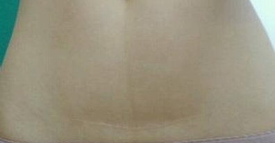 剖腹产疤痕怎么快速消除小妙招,一白遮百丑的调理方法