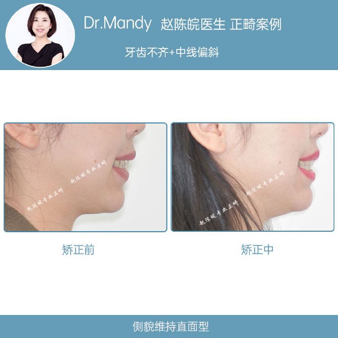 正畸牙齿不齐案例,牙齿拥挤正畸真实案例