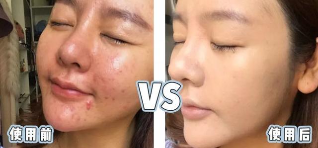 张韶涵澳洲玲珑面膜,张韶涵护肤敏感肌