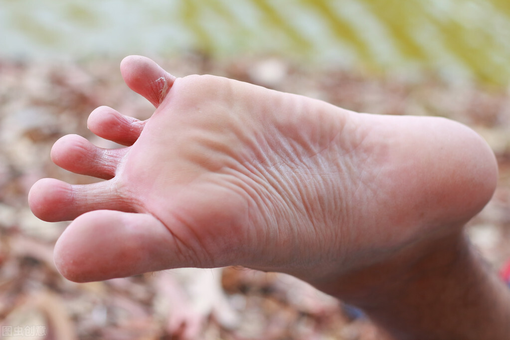 虫咬性皮炎高发医生支招来防范,虫咬性皮炎预防妙招