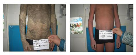 女孩离奇变石头人,印度专家一脸懵,中医鱼鳞病专家却这样说