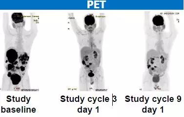 肿瘤缩小90%,胃肠间质瘤新药上市