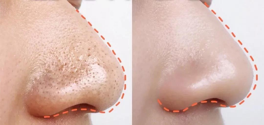 用了神仙水皮肤很干,用神仙水皮肤有刺痛感