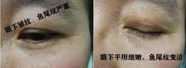 去眼纹去黑眼圈用什么方法,去眼袋黑公认最好用的土方法