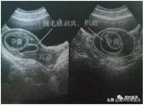 妇科常见疾病的超声诊断视频,超声常见疾病