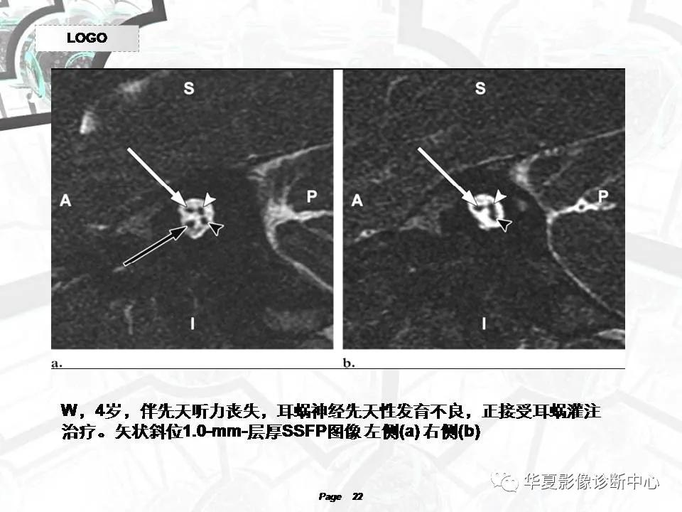 磁共振颅神经扫描是定位在哪,颅神经图谱