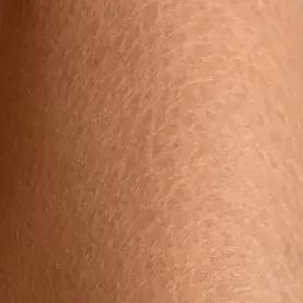 又到了穿小裙的季节，鸡皮女孩该怎么办……