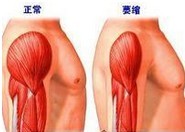 肩膀痛抬不起来不一定是肩周炎,青少年肩周炎肩膀抬不起来