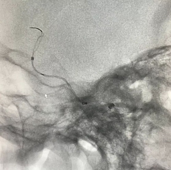 Tubridge®治疗多发性动脉瘤