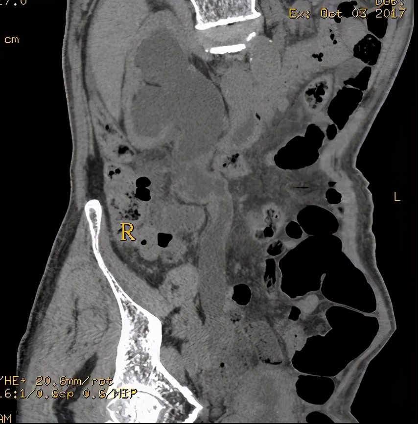 尿路造影输尿管间断显影,静脉尿路造影和排泄性尿路造影