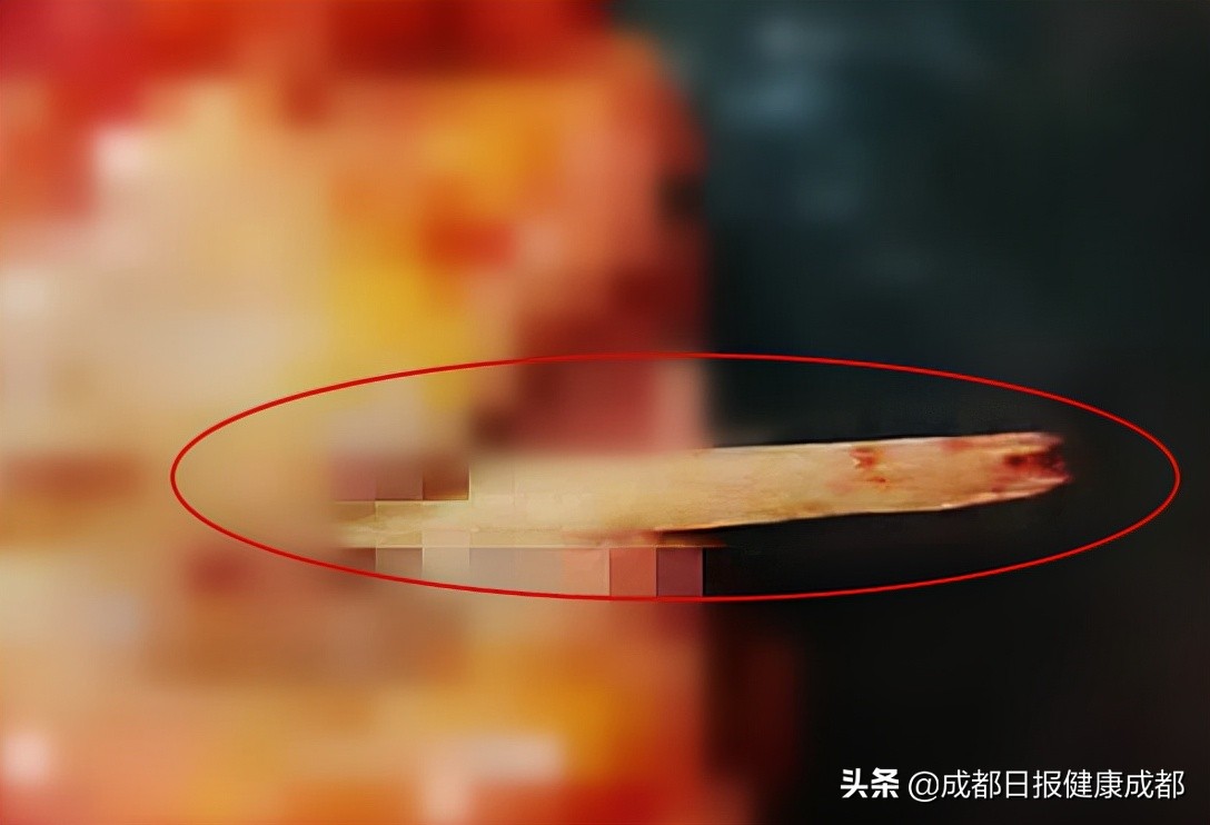 胃及十二指肠穿孔疼痛特点,胃病上腹疼痛