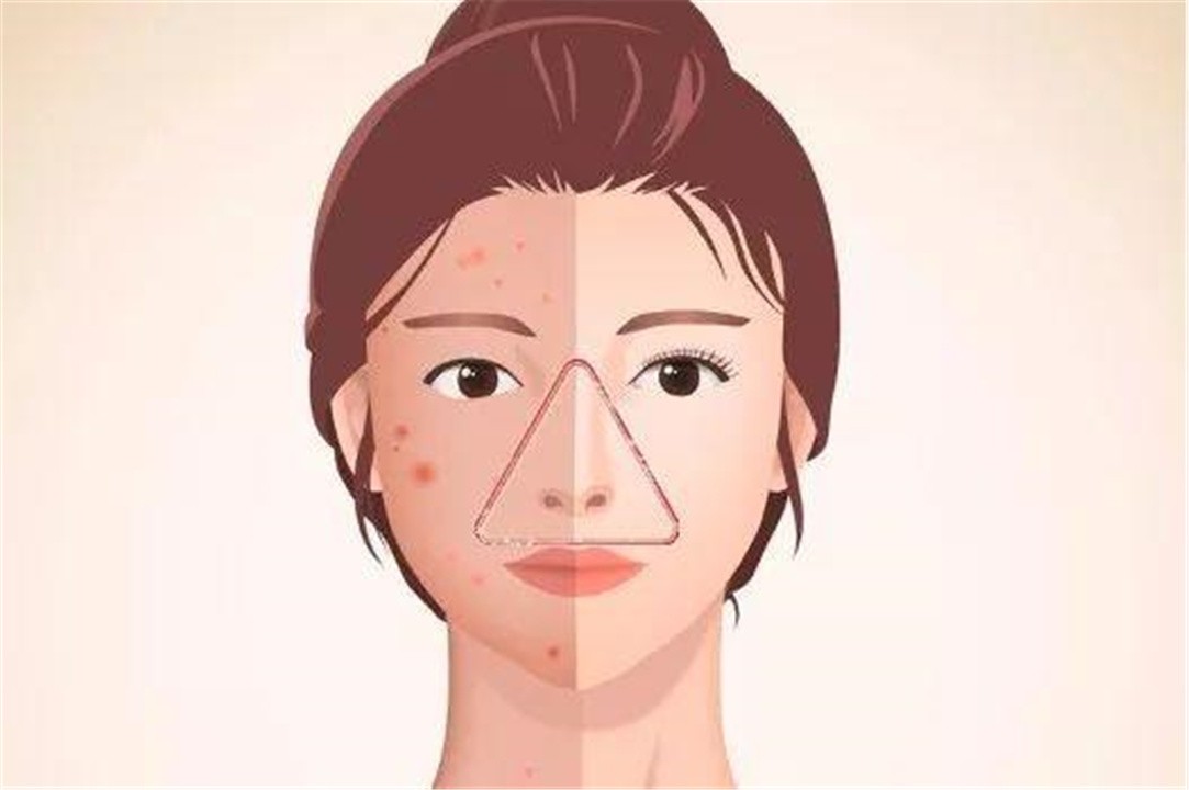 “危险三角区”的痘痘千万不能挤！有人挤了一下，结果留下后遗症