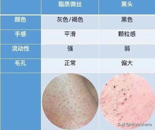 应该怎么正确对待黑头,什么办法才能真正解决黑头