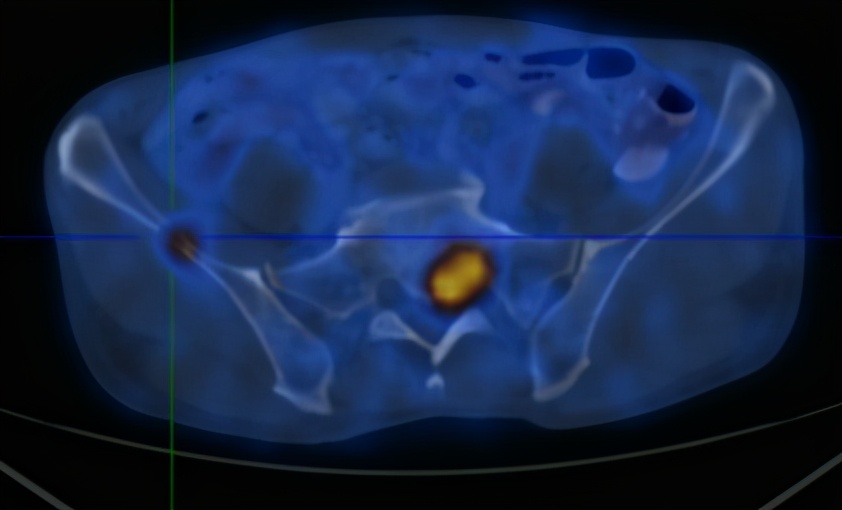 腰痛与肺癌有关吗,腰痛的厉害是得了肾癌吗