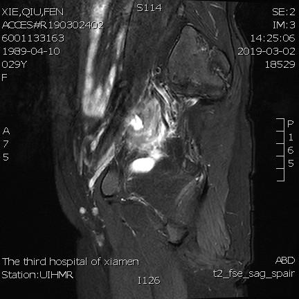 子宫腺肌症介入栓塞全国哪里好,子宫腺肌症介入栓塞治疗报销吗