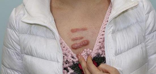 疤痕疙瘩可以去除吗?如何去除?