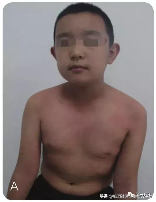 手足口病及水痘等传染病防控知识,手足口病和幼儿急疹和水痘的区别