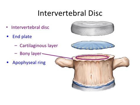 椎间盘突出痛苦,慢性腰椎间盘突出