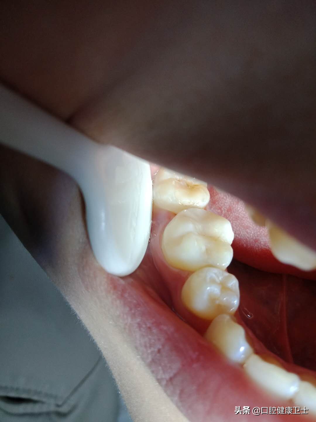 补牙后感觉牙缝被堵上了,补牙后牙缝疼痛是什么原因引起的