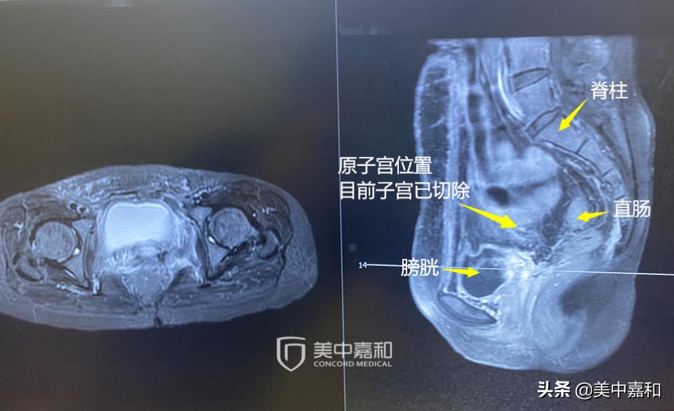 早期癌症全切能根治吗,早期癌症切除了就没事了吗
