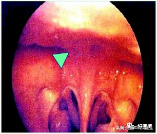 咽喉疾病科普知识,咽喉疾病动画科普视频