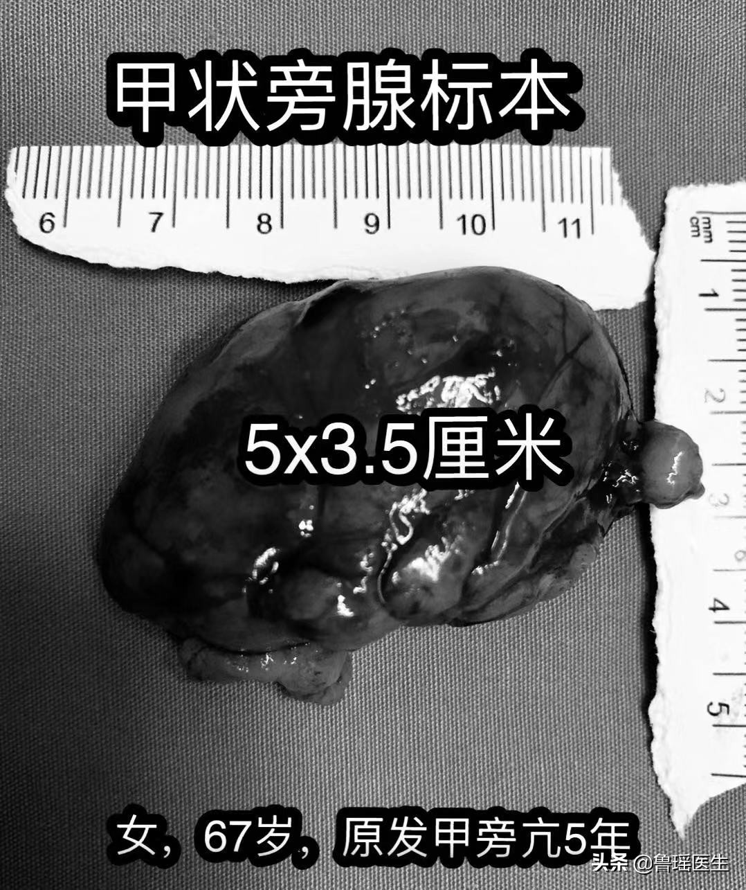 尿道结石会导致腹胀消化不良吗,关节炎和尿路结石是什么代谢异常