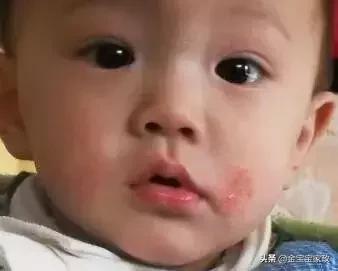 婴儿湿疹的原因和治疗方法,湿疹是什么原因造成的要怎么预防