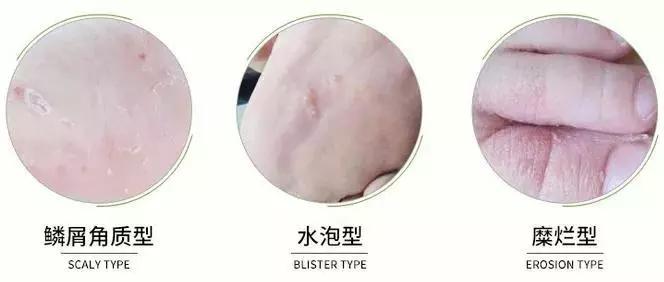 去除脚臭最有效的喷雾,去脚臭最有效方法喷雾