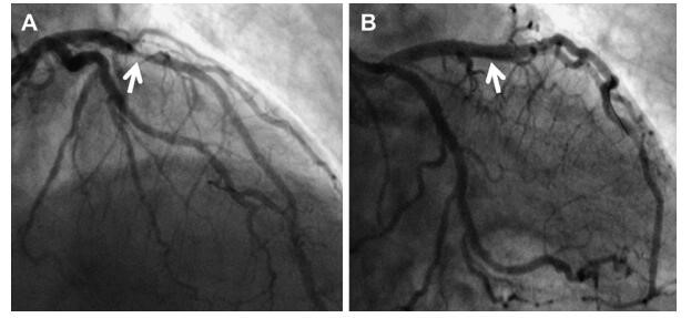 心梗不做搭桥能保守治疗吗,冠心病不支架可以治愈吗
