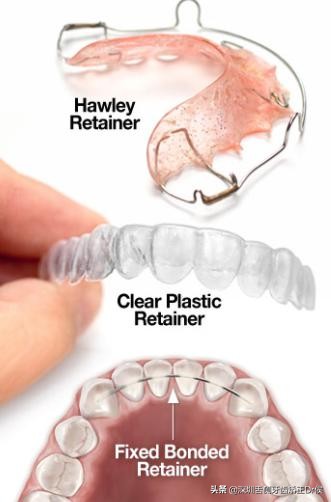 保持器怎么做微调,保持器该怎么选