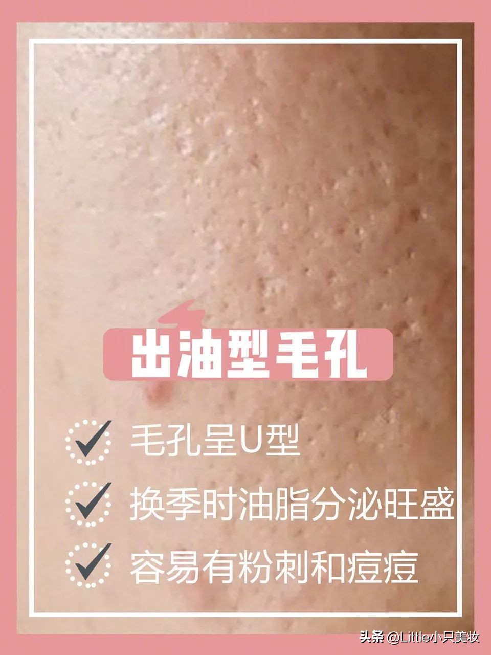 简单几招让你迅速解决粗大毛孔,改善毛孔粗大最有效的办法测评