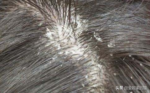 头屑多头痒用什么洗发水比较好,头屑多比较油用什么洗发水最好