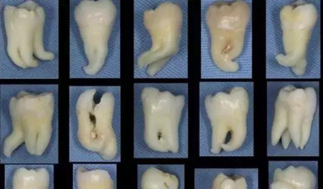 拔大牙烂牙根,烂牙根没拔干净