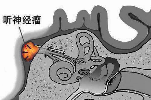 长了听神经瘤可以做微创手术吗？手术风险大吗？