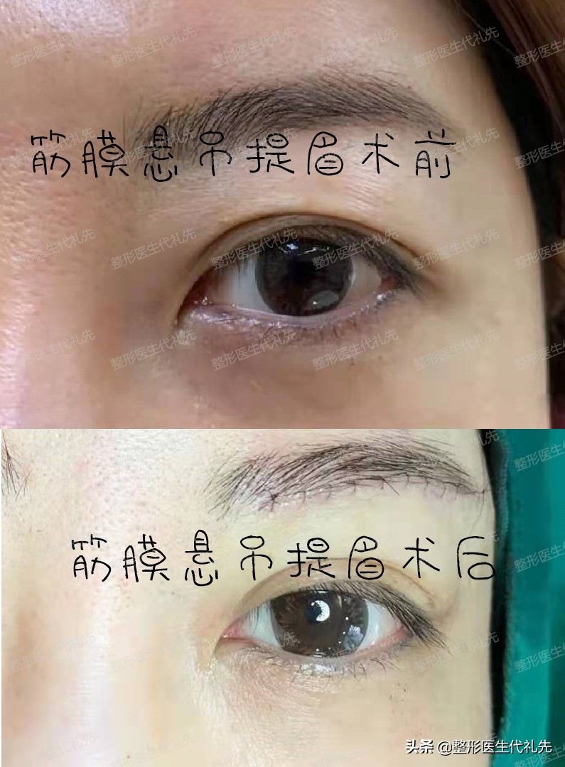 提眉手术的说法,提眉整形问答
