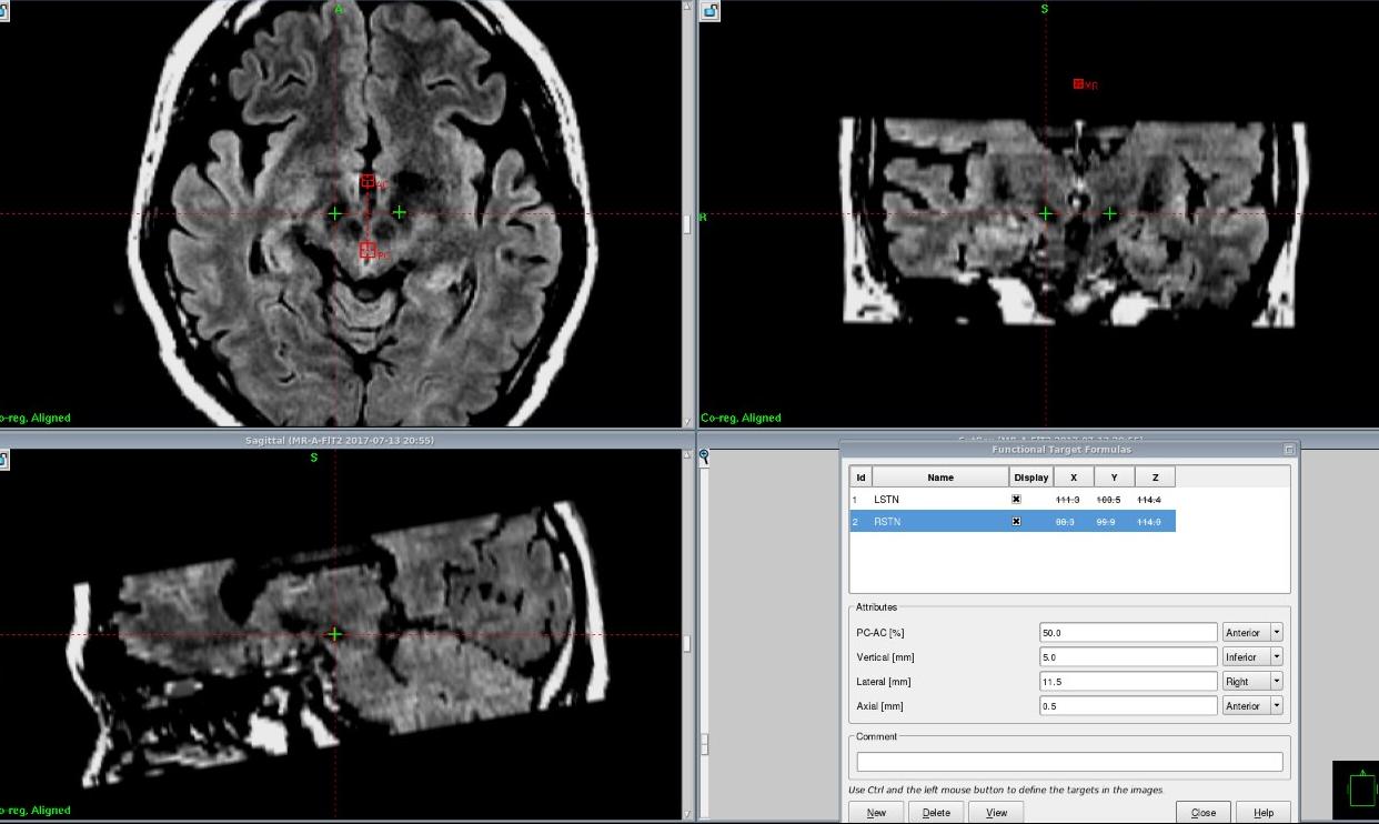 帕金森脑深部刺激手术后怎么恢复,脑深部电刺激能治愈帕金森吗
