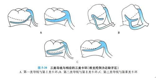 牙列缺损的可摘局部义齿修复题库,牙科美学修复精讲