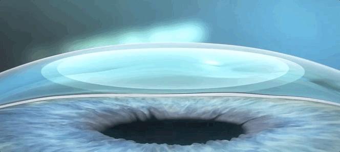 激光近视矫正手术有什么后遗症,激光矫正近视和散光有什么后遗症