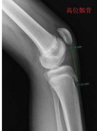 膝前疼痛,膝前痛危险因素